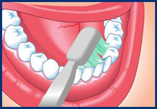 Clean every surface of every tooth. This means you must brush the cheek side, the tongue side and the top of each tooth