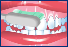 Hold the toothbrush at a 45-degree angle to the teeth. Point the bristles to where the gums and teeth meet
