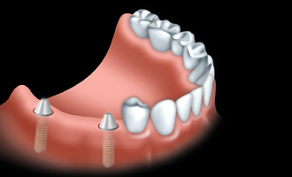 A fixed bridge is anchored to dental implants to replace one or more teeth
